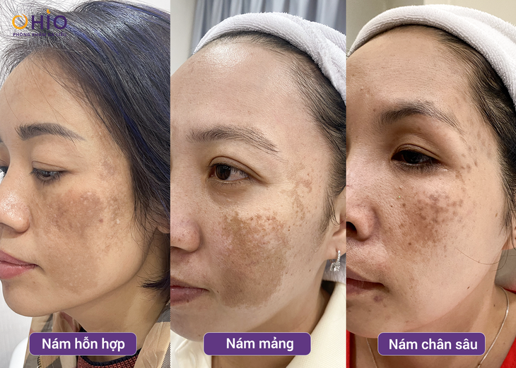 Phác đồ PBS Premium – Giải pháp cho các trường hợp tăng sắc tố da, nám da- Ảnh 1. Phác đồ PBS Premium – Giải pháp cho các trường hợp tăng sắc tố da, nám da- Ảnh 1.