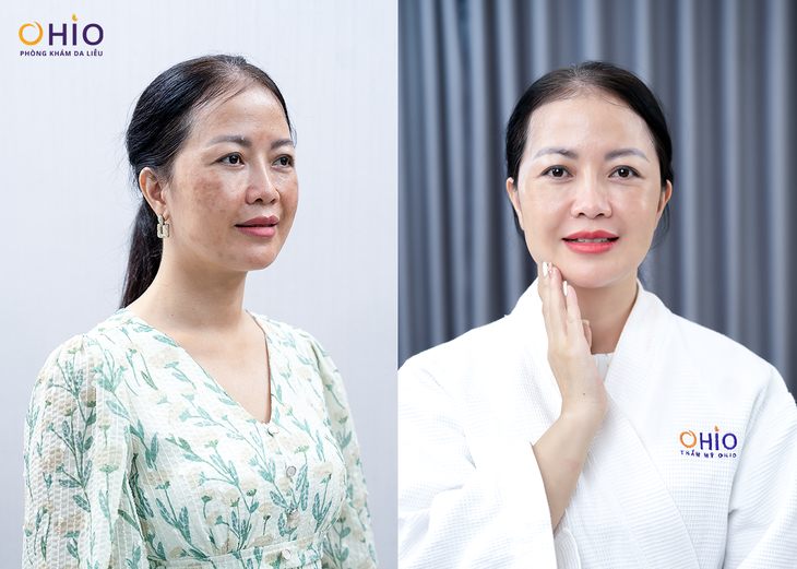 Phác đồ PBS Premium – Giải pháp cho các trường hợp tăng sắc tố da, nám da- Ảnh 4. Phác đồ PBS Premium – Giải pháp cho các trường hợp tăng sắc tố da, nám da- Ảnh 4.