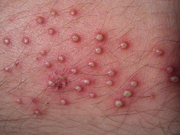 Các thuốc điều trị viêm nang lông- Ảnh 1. Các thuốc điều trị viêm nang lông- Ảnh 1.