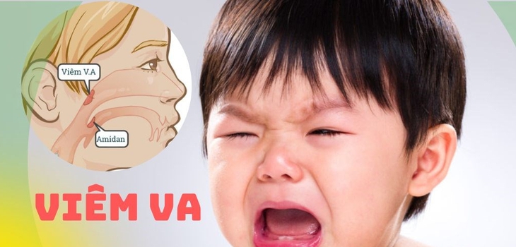 Cho bé thăm khám định kỳ và tuân thủ liệu trình của bác sĩ đẻ tránh viêm VA tái phát gây nhiều biến chứng không mong muốn. Cho bé thăm khám định kỳ và tuân thủ liệu trình của bác sĩ đẻ tránh viêm VA tái phát gây nhiều biến chứng không mong muốn.