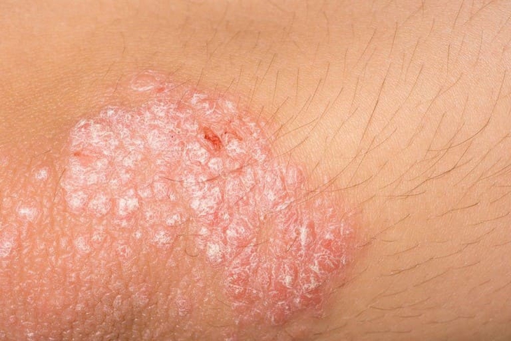 Mới Bị Vảy Nến Nhẹ - Cách Chăm Sóc Và Khắc Phục Nhanh