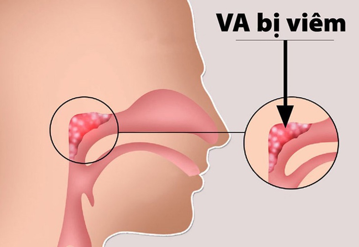 Viêm VA là bệnh thường gặp ở trẻ nhỏ với biểu hiện nghẹt mũi, khó chịu, khiến trẻ mệt mỏi, biếng ăn... Viêm VA là bệnh thường gặp ở trẻ nhỏ với biểu hiện nghẹt mũi, khó chịu, khiến trẻ mệt mỏi, biếng ăn...