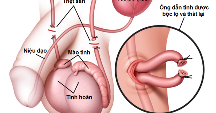 Vợ có bầu sau khi chồng đã thắt ống dẫn tinh