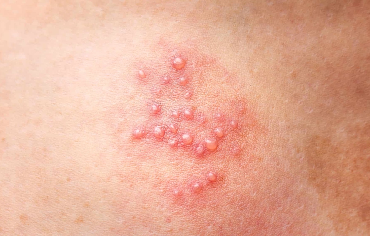 Phân biệt Herpes và nhiệt miệng- Ảnh 2. Phân biệt Herpes và nhiệt miệng- Ảnh 2.