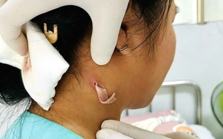 Đồng Nai ghi nhận bệnh nhi đầu tiên nhiễm vi khuẩn gây bệnh Whitmore