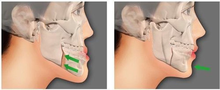 8 câu hỏi thường gặp về chấn thương hàm mặt- Ảnh 1.