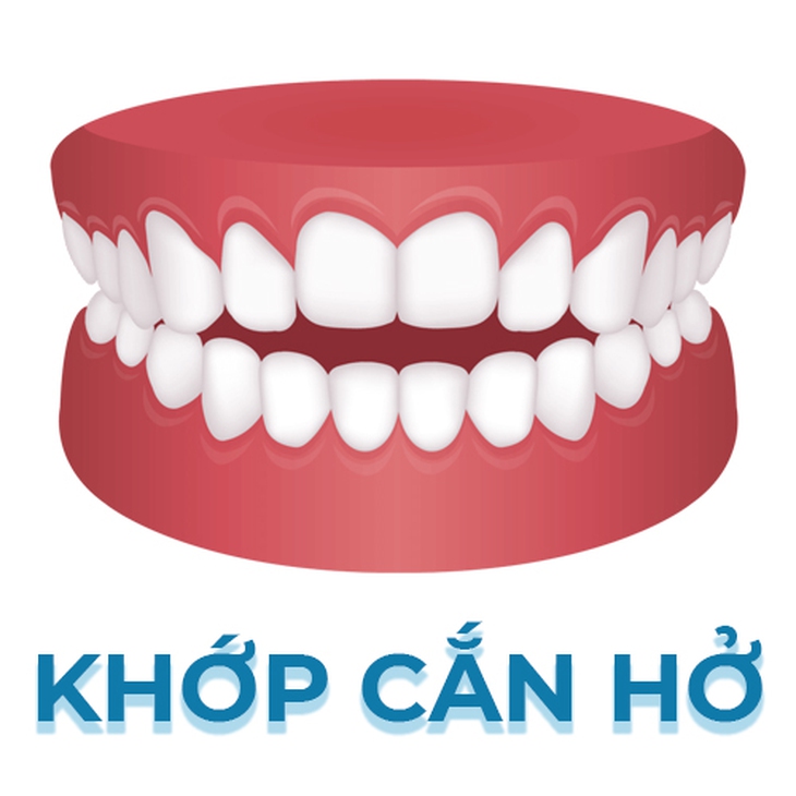 Lệch khớp cắn: Nguyên nhân, biểu hiện, cách điều trị và phòng bệnh- Ảnh 3. Lệch khớp cắn: Nguyên nhân, biểu hiện, cách điều trị và phòng bệnh- Ảnh 3.