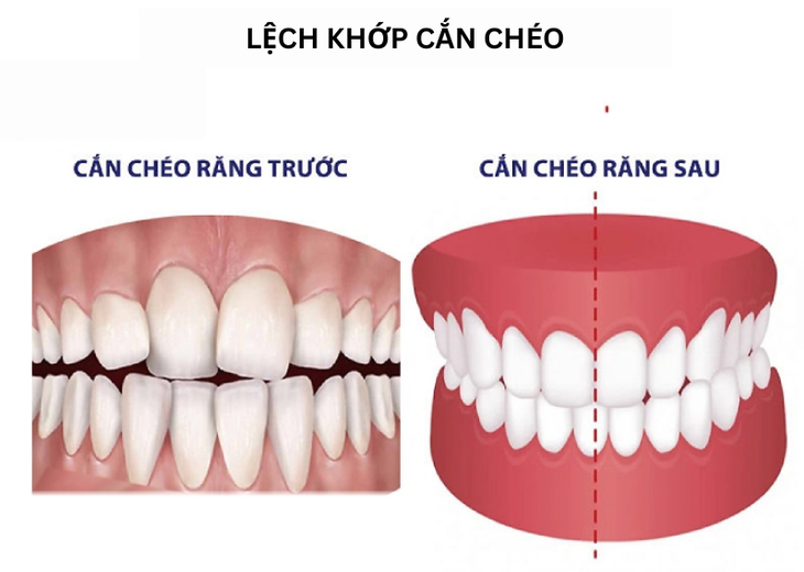 Lệch khớp cắn: Nguyên nhân, biểu hiện, cách điều trị và phòng bệnh- Ảnh 2. Lệch khớp cắn: Nguyên nhân, biểu hiện, cách điều trị và phòng bệnh- Ảnh 2.