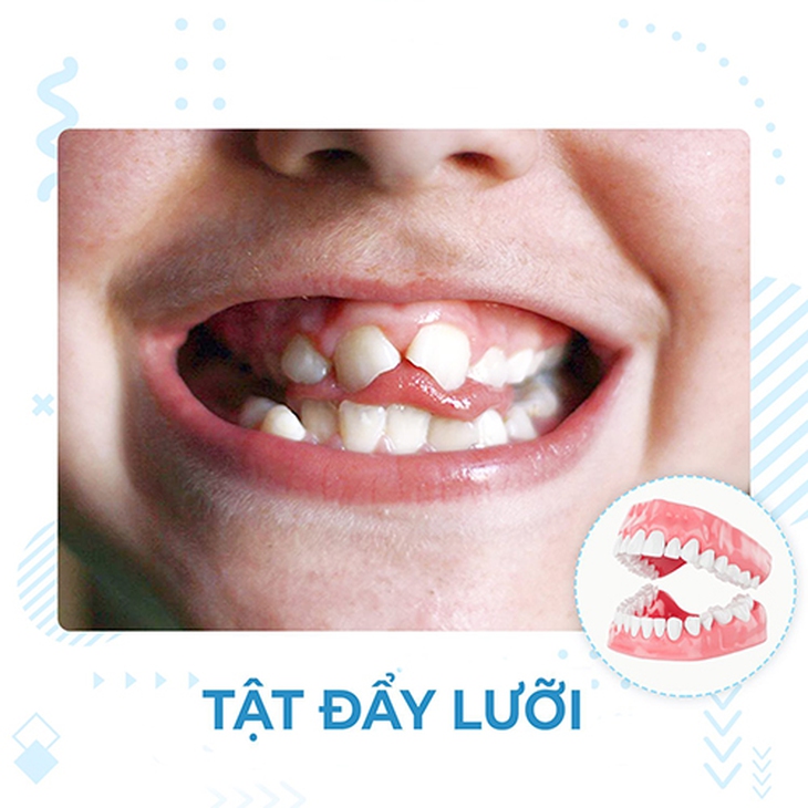 Lệch khớp cắn: Nguyên nhân, biểu hiện, cách điều trị và phòng bệnh- Ảnh 4. Lệch khớp cắn: Nguyên nhân, biểu hiện, cách điều trị và phòng bệnh- Ảnh 4.