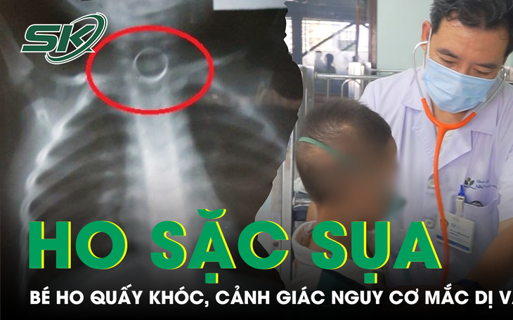 Ho sặc 30 phút sau bữa ăn, phát hiện xương cá hình chữ T mắc trong khí quản- Ảnh 3.