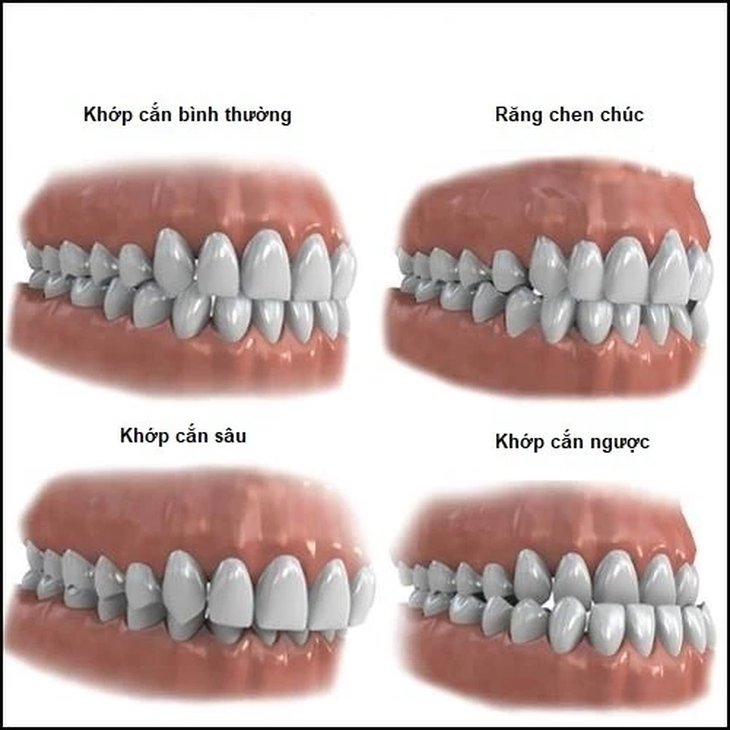 Các phương pháp điều trị lệch khớp cắn- Ảnh 2.