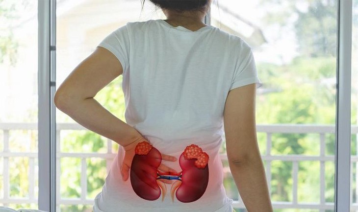 Áp xe thận: Nguyên nhân, biểu hiện, cách điều trị và phòng bệnh- Ảnh 1. Áp xe thận: Nguyên nhân, biểu hiện, cách điều trị và phòng bệnh- Ảnh 1.