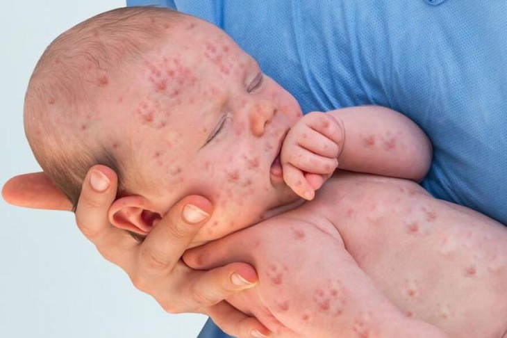 Bị sởi có nên tắm không?- Ảnh 1. Bị sởi có nên tắm không?- Ảnh 1.
