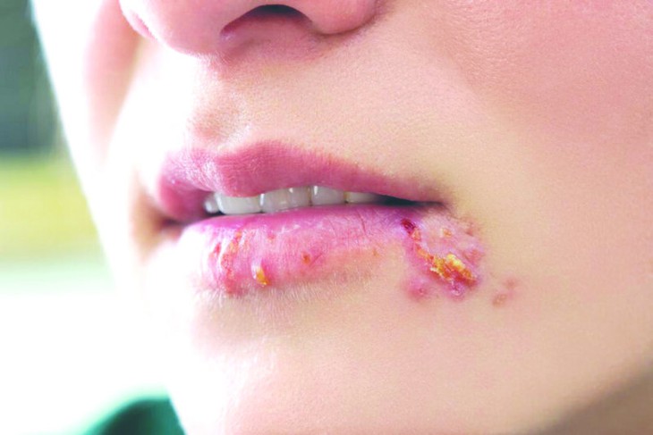 Những điều cần biết về mụn rộp Herpes- Ảnh 1. Những điều cần biết về mụn rộp Herpes- Ảnh 1.