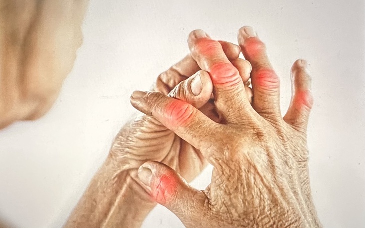 Chế độ ăn cho người bệnh Still - viêm khớp hiếm gặp