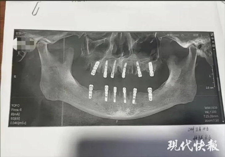 Người đàn ông tử vong sau khi nhổ 23 chiếc răng và trồng 12 răng giả cùng lúc- Ảnh 1. Người đàn ông tử vong sau khi nhổ 23 chiếc răng và trồng 12 răng giả cùng lúc- Ảnh 1.