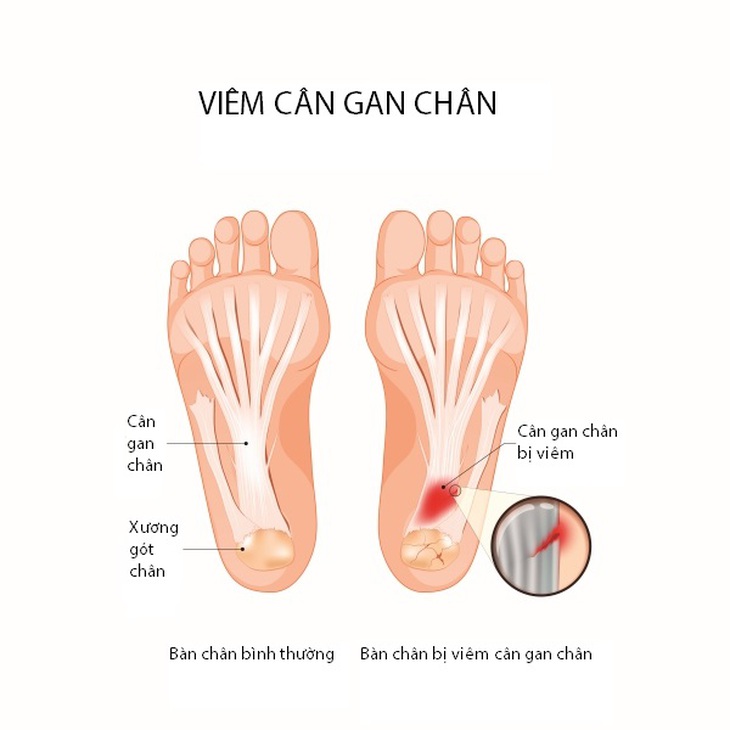 Viêm cân gan chân: Nguyên nhân, triệu chứng, phòng bệnh và cách điều trị- Ảnh 1. Viêm cân gan chân: Nguyên nhân, triệu chứng, phòng bệnh và cách điều trị- Ảnh 1.