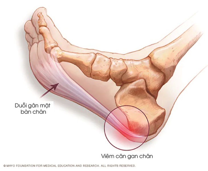 Viêm cân gan chân: Nguyên nhân, triệu chứng, phòng bệnh và cách điều trị- Ảnh 3. Viêm cân gan chân: Nguyên nhân, triệu chứng, phòng bệnh và cách điều trị- Ảnh 3.