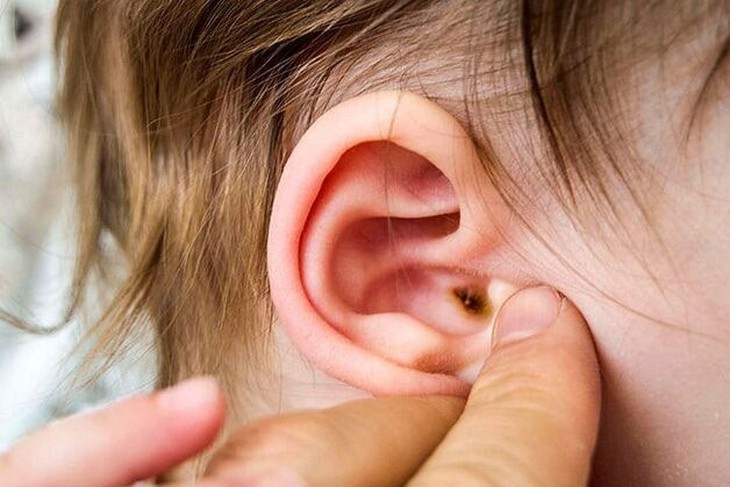 Khi đợt cấp đã điều trị ổn định, bạn nên có các biện pháp dự phòng bệnh tái phát, giữ cho tai được khô. Ảnh minh họa