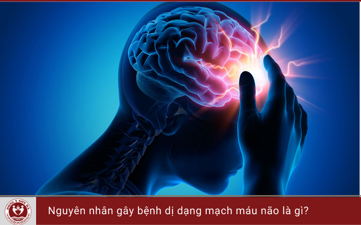 Cảnh giác với dị dạng mạch máu não