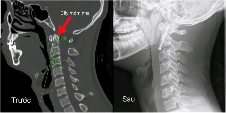 Bác sĩ Bệnh viện Bạch Mai phẫu thuật gãy cột sống cổ phức tạp chỉ qua đường mổ 1cm- Ảnh 1.