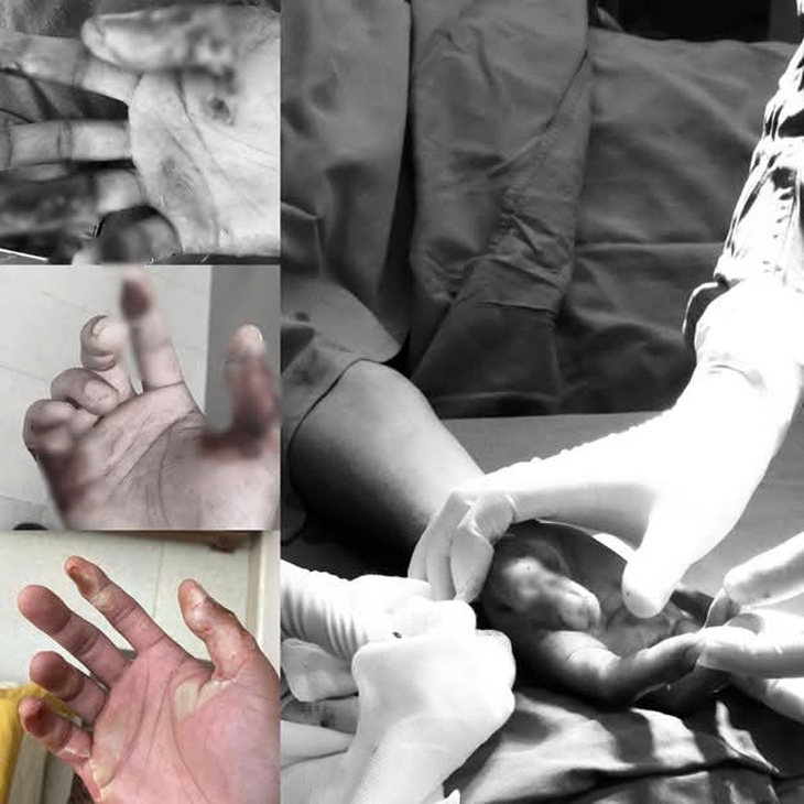 Nhiễm trùng nặng vì bôi cao sim chữa bỏng bô xe máy- Ảnh 1. Nhiễm trùng nặng vì bôi cao sim chữa bỏng bô xe máy- Ảnh 1.