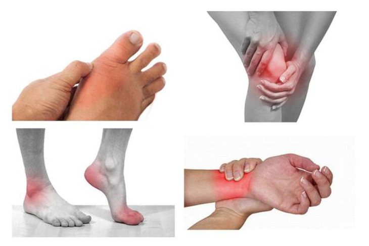 Điều trị hội chứng Felty bằng cách nào?- Ảnh 1.