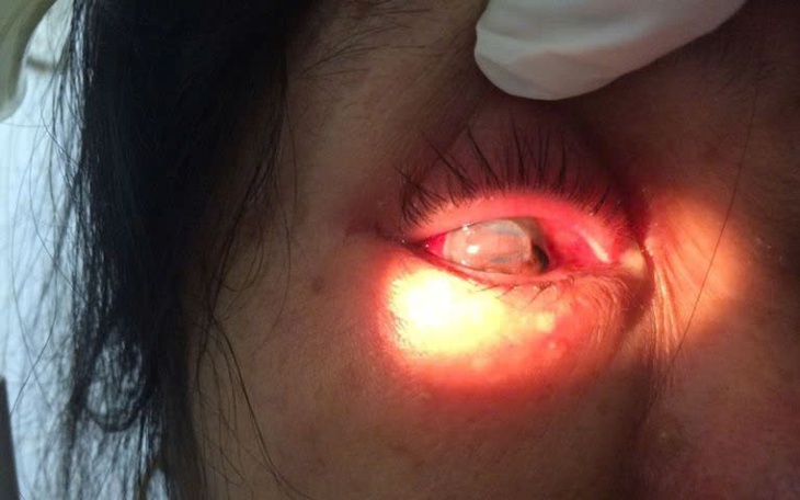 Bệnh lý dịch kính võng mạc: Nguyên nhân thứ hai gây mù lòa