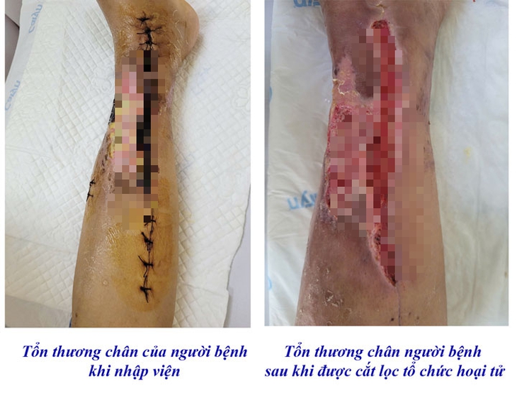 Giảm nguy cơ cắt cụt chi cho bệnh nhân nhờ điều trị bằng máy hút áp lực âm- Ảnh 1. Giảm nguy cơ cắt cụt chi cho bệnh nhân nhờ điều trị bằng máy hút áp lực âm- Ảnh 1.