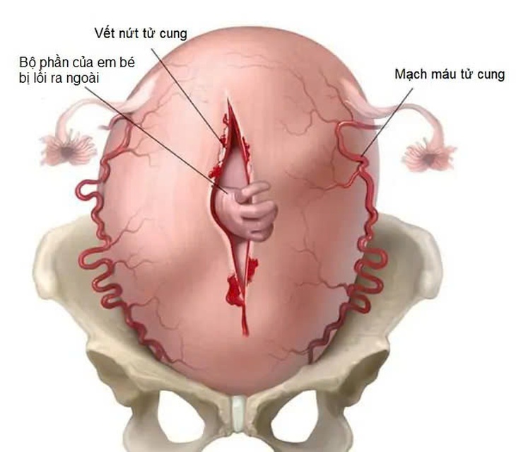 Bệnh vỡ tử cung: Nguyên nhân, triệu chứng, phòng bệnh và cách điều trị- Ảnh 3. Bệnh vỡ tử cung: Nguyên nhân, triệu chứng, phòng bệnh và cách điều trị- Ảnh 3.