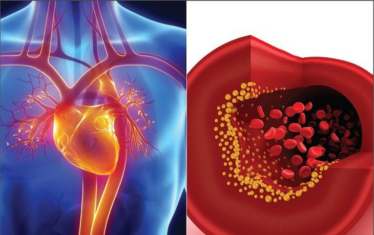 Rối loạn mỡ máu ở người cao tuổi nên ăn gì?- Ảnh 1.
