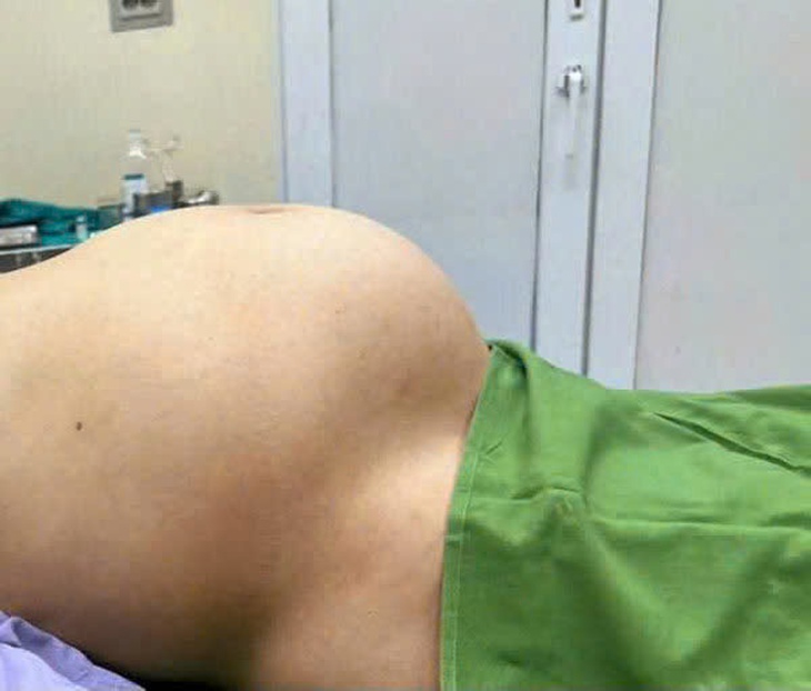 Người phụ nữ 65 tuổi bụng to như bầu 8 tháng đi khám phát hiện u nang buồng trứng - Ảnh 1. Người phụ nữ 65 tuổi bụng to như bầu 8 tháng đi khám phát hiện u nang buồng trứng - Ảnh 1.
