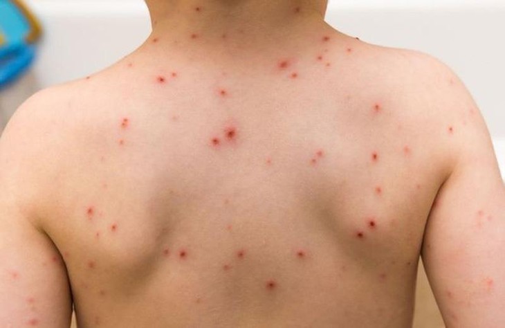 Tăng ca mắc bệnh sởi ở Khánh Hòa, bác sĩ khuyến cáo điều các gia đình cần nhớ- Ảnh 1. Tăng ca mắc bệnh sởi ở Khánh Hòa, bác sĩ khuyến cáo điều các gia đình cần nhớ- Ảnh 1.