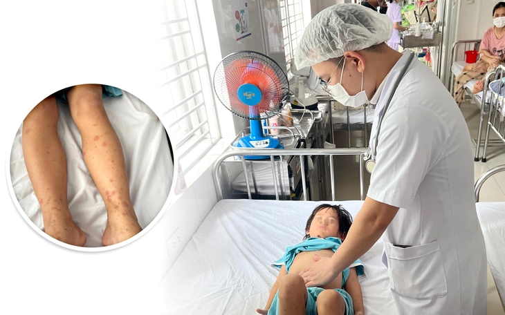 Cảnh giác với viêm mao mạch dị ứng ở trẻ từ những biểu hiện dễ bỏ qua dưới đây