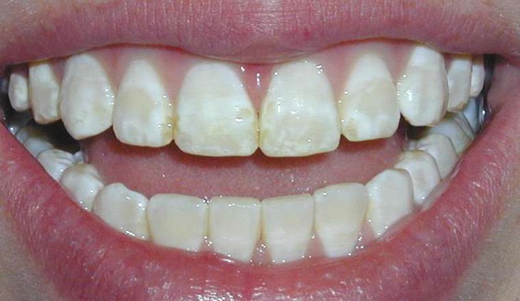 Những việc làm cực kì có hại cho men răng- Ảnh 1.