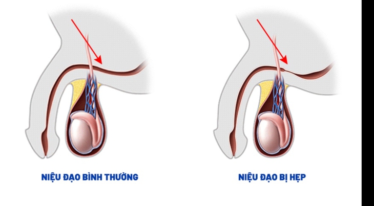 Hẹp niệu đạo: Nguyên nhân, biểu hiện, cách điều trị và phòng bệnh- Ảnh 1.