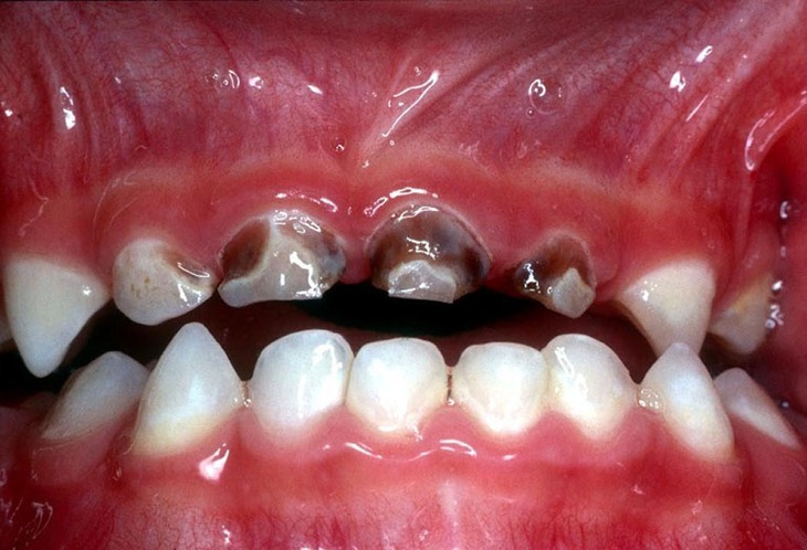 Hội chứng sâu răng do bú bình - Ảnh 1.