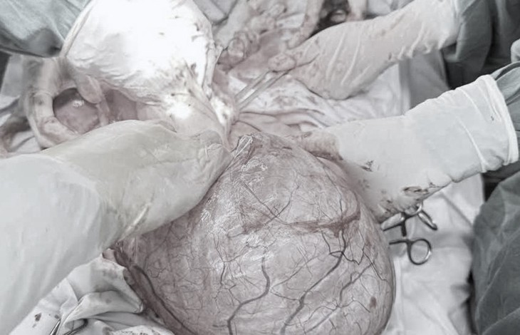 Mang khối u buồng trứng nặng gần 4kg, sản phụ sinh bé trai khỏe mạnh- Ảnh 1.