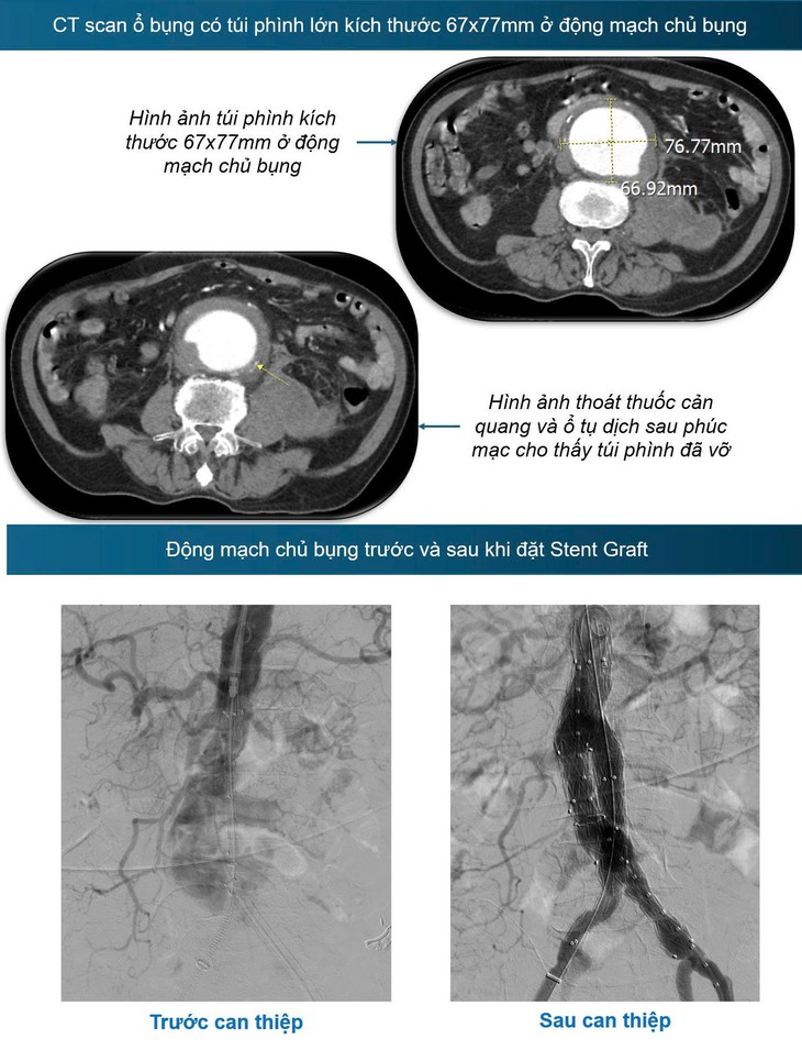 Cứu sống bệnh nhân vỡ động mạch chủ bụng bằng Stent graft- Ảnh 1.