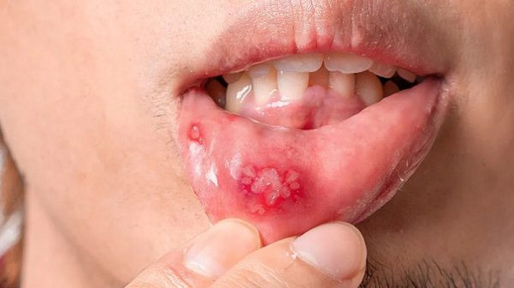 Vết thương hở và nguy cơ lây truyền HIV: Hiểu rõ để phòng ngừa hiệu quả- Ảnh 1.