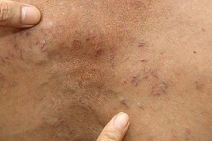 Nhiễm ấu trùng sán dây lợn từ thói quen ăn thực phẩm sống và cách phát hiện sớm- Ảnh 1.