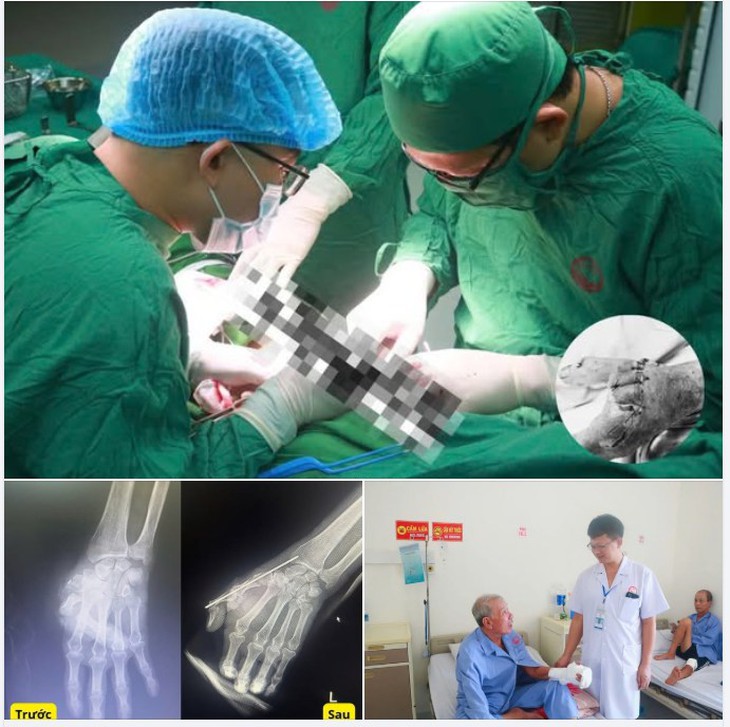 Bác sĩ cứu sống bàn tay bị vỡ nát cho bệnh nhân sau tai nạn giao thông- Ảnh 1.