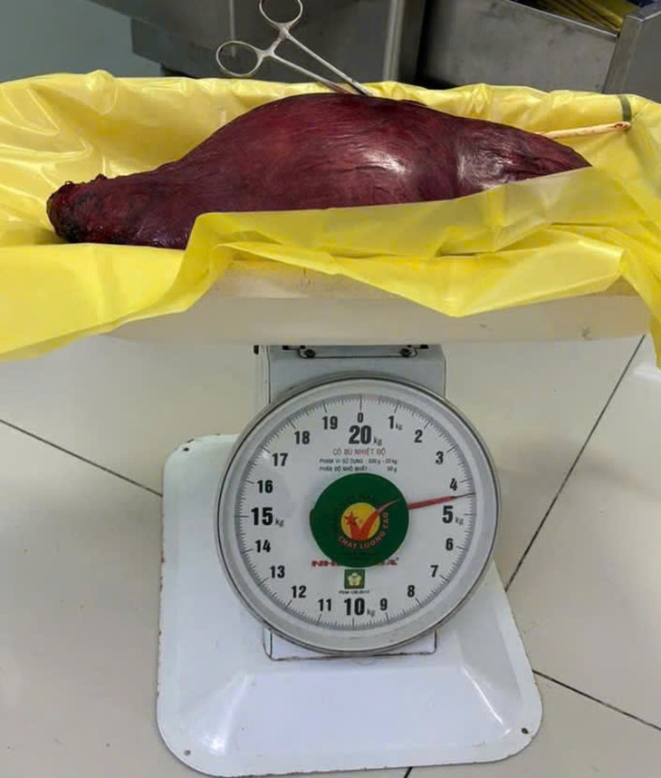 Cắt khối u xơ tử cung nặng 4,5kg, bụng nữ bệnh nhân to như thai 28 tuần- Ảnh 2.