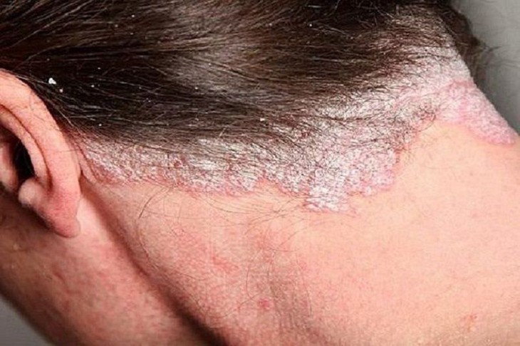 Ai dễ bị nhiễm nấm da đầu, biểu hiện nấm da đầu?- Ảnh 1.