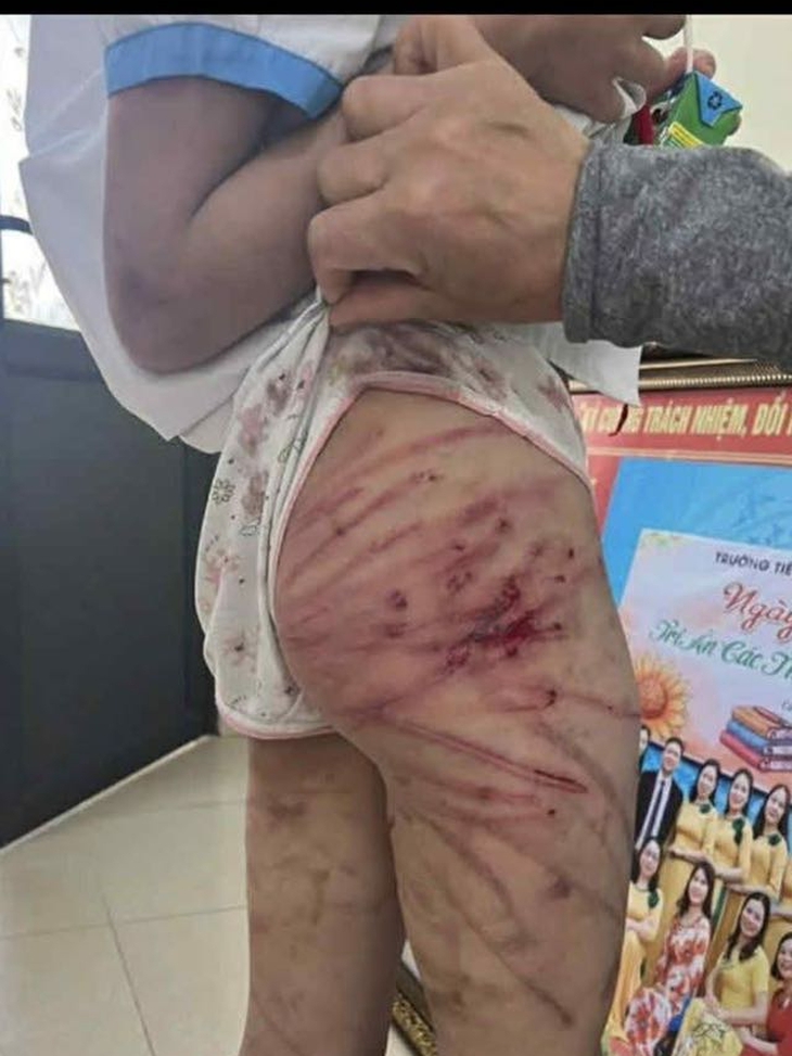 Xác minh thông tin bé gái nghi bị cha dượng bạo hành dã man- Ảnh 1.