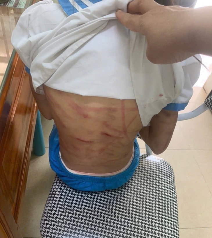 Xác minh thông tin bé gái nghi bị cha dượng bạo hành dã man- Ảnh 2.