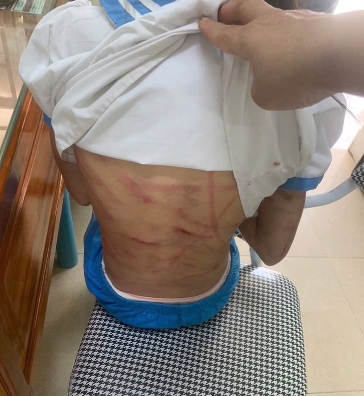 Công an triệu tập cha dượng nghi bạo hành bé gái- Ảnh 1.