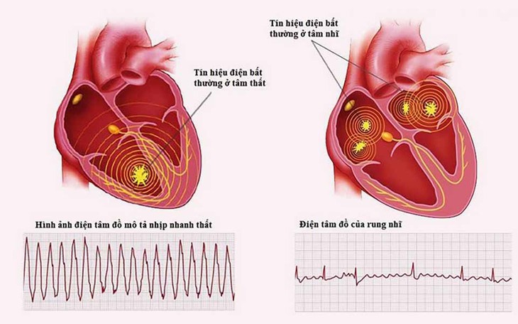 Tại sao rung nhĩ lại nguy hiểm?