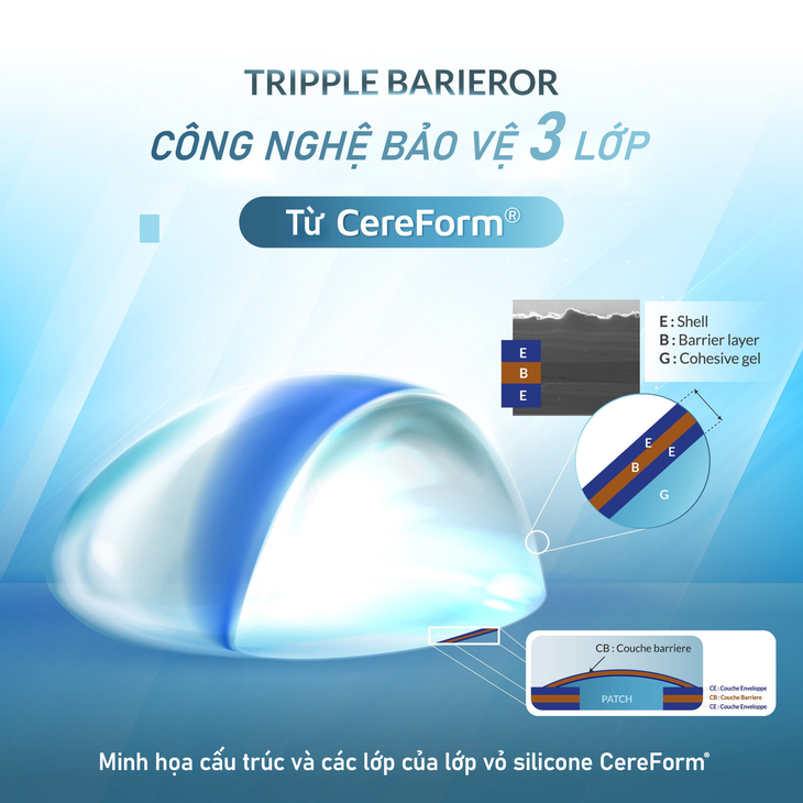 Túi ngực Cereform đạt chuẩn châu Âu chính thức phân phối tại Việt Nam- Ảnh 2. Túi ngực Cereform đạt chuẩn châu Âu chính thức phân phối tại Việt Nam- Ảnh 2.