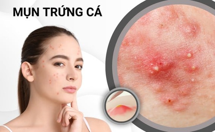 7 dấu hiệu trên da cảnh báo viêm ruột và cách phòng ngừa- Ảnh 1.